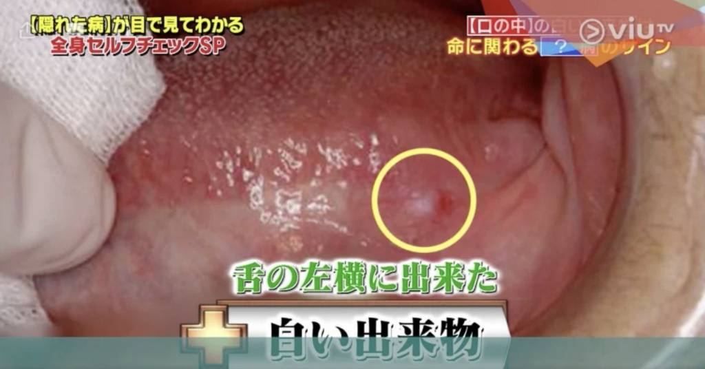 舌癌的症状初期外表像「飞滋」,大部分人都会以为是口腔炎,延误了