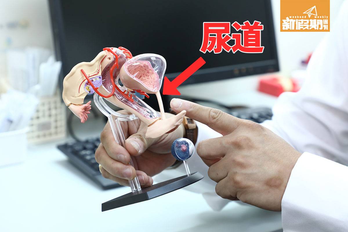 陰道鬆弛 尿道與陰道的位置非常接近，醫生手指的位置，就是尿道。