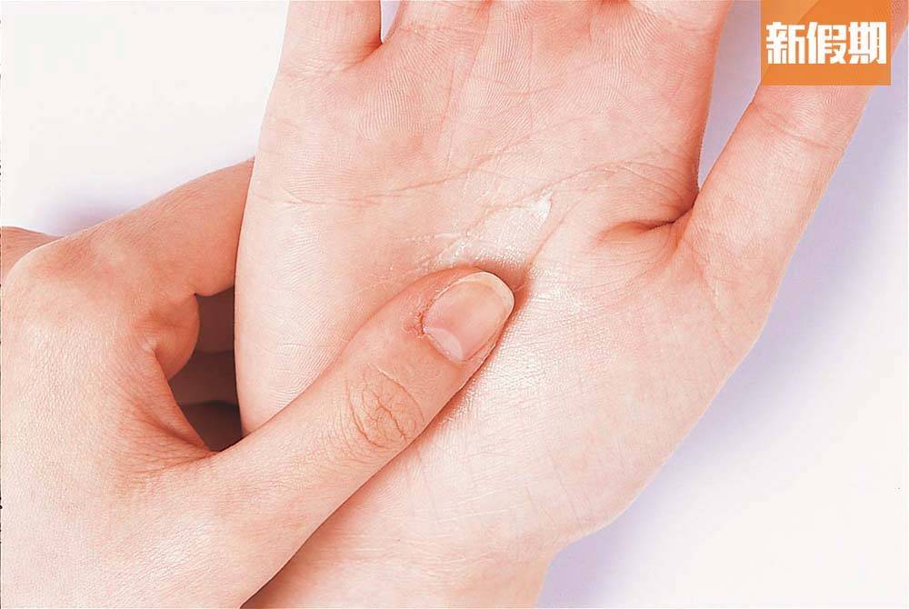 洗手 當雙手開始出現痕癢時，別要亂抓痕癢位置，以免抓傷皮膚，減低感染傷口的危機。