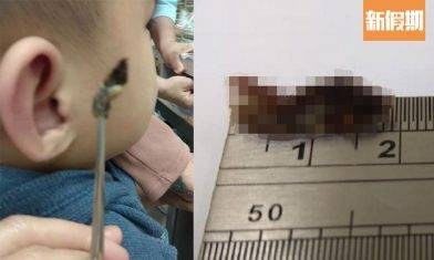 清理耳屎正確方法！台灣3歲童疑失聰 醫生夾出2cm「巨型耳垢」｜好生活百科