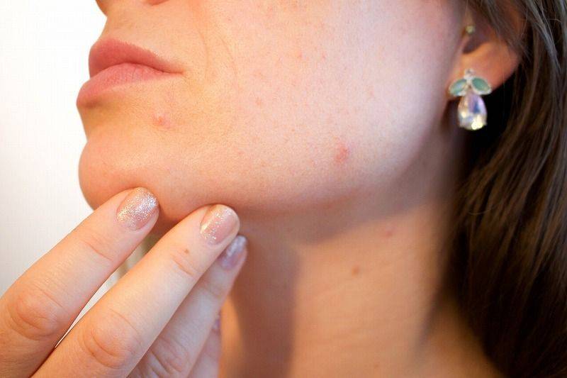 暗瘡膏推薦:這9款有效消炎、抗菌、去疤、對抗石頭瘡 一支走天涯|好生活百科