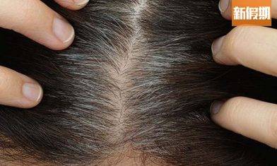 白頭髮位置｜檢測身體健康狀況及7個有效解決方法