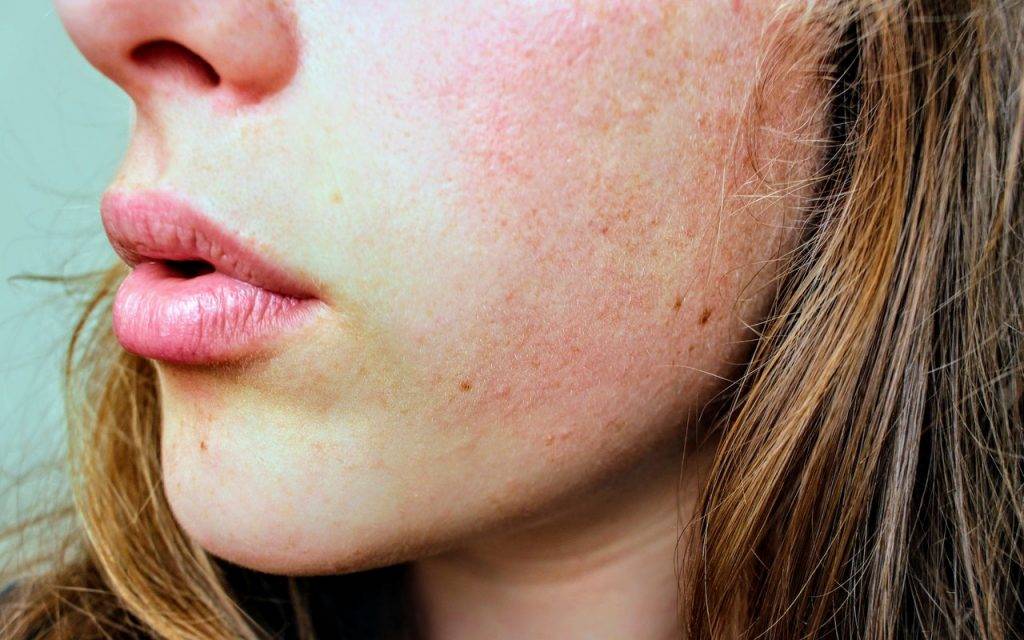 濕疹 重則臉部呈現紅、腫、熱、痛的發炎徵狀，影響心情