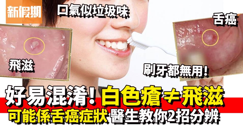 舌癌、飛滋易混淆:都有白色瘡!舌癌死亡率極高 醫生教你2招分辨|好生活百科