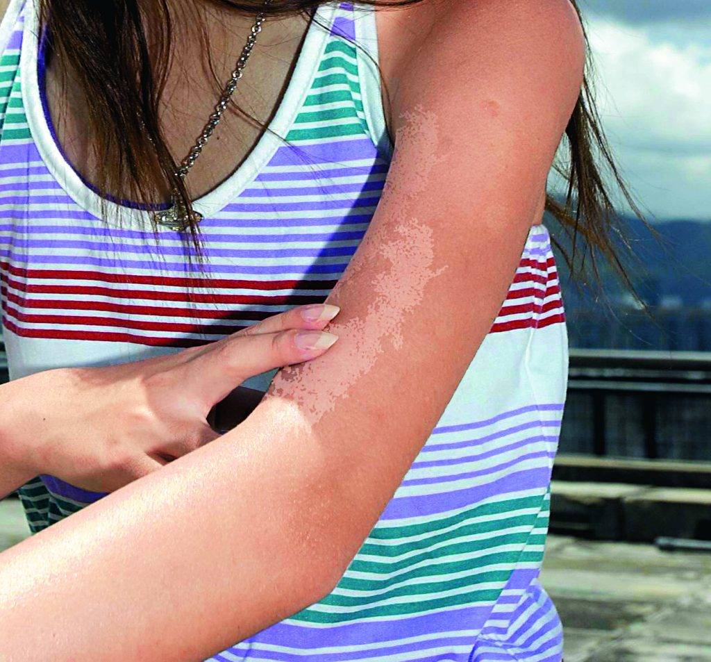 汗斑 (變色糠疹, Pityriasis or Tinea versicolor) – 肌膚親清—陳文國醫師的5分鐘皮膚專欄