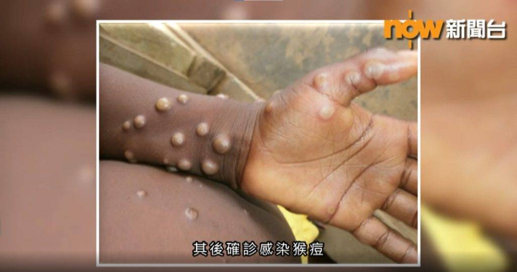 猴痘病毒 猴痘 患者身體會開始出現皮疹。
