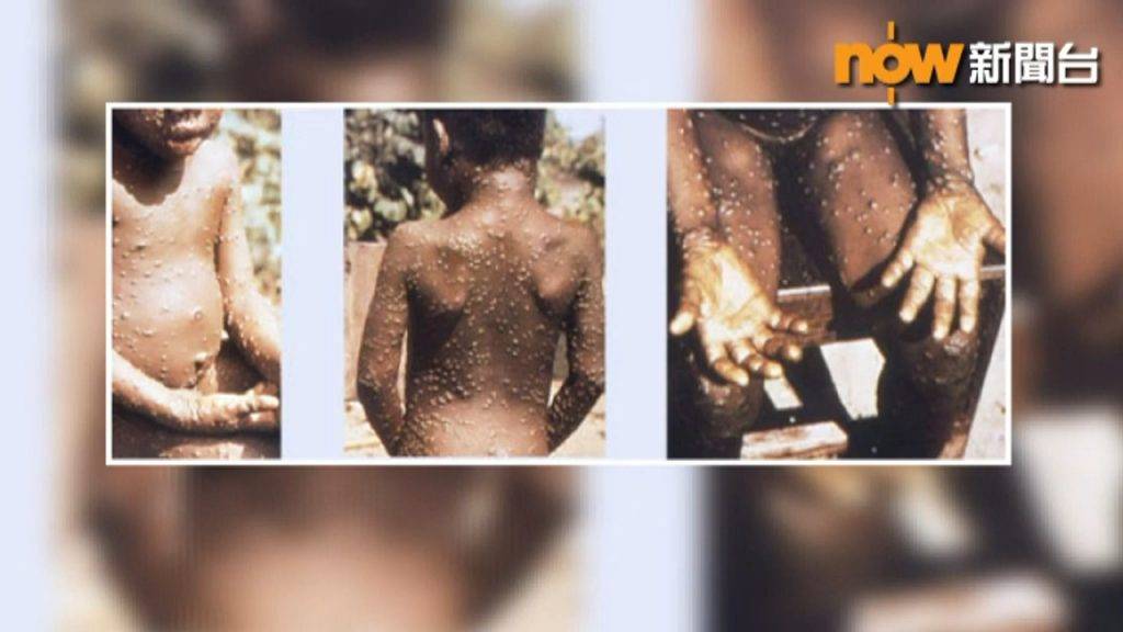 猴痘病毒 猴痘 以往猴痘多數出現在非洲，今次是種傳染病首次在沒去過非洲的人士之間傳播。