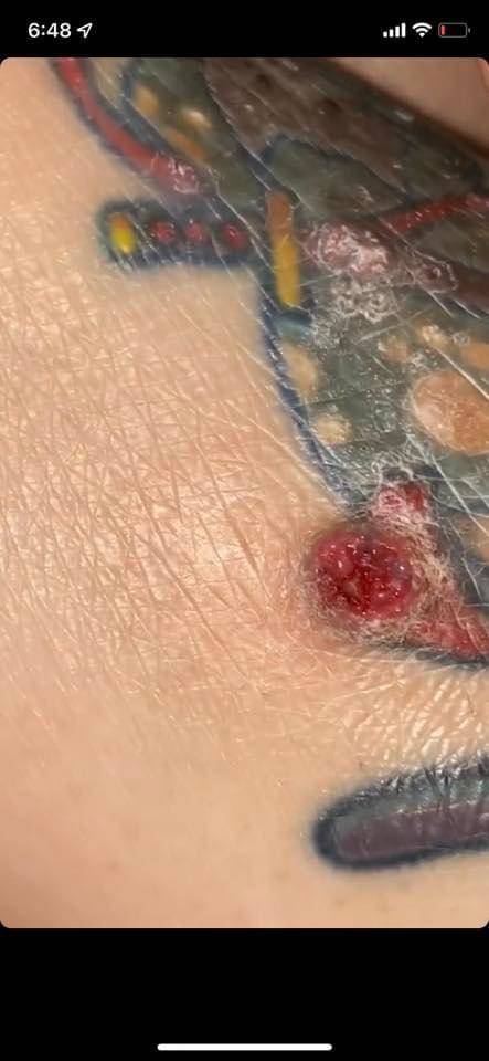 紋身 其中一位苦主更在紋身上長出一粒肉瘡，經網上媒體報道疑似是人類乳突病毒HPV)！！！