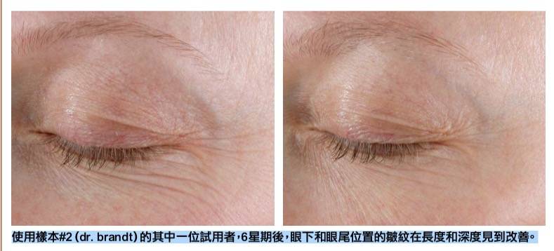 消委會眼霜 使用樣本#2dr. brandt)的其中一位試用者，6星期後，眼下和眼尾位置的皺紋在長度和深度見到改善。