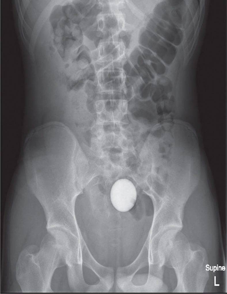 肛門 在24小時後，醫生再為少年照X光，但高爾夫球在少年體內的位置仍然沒變