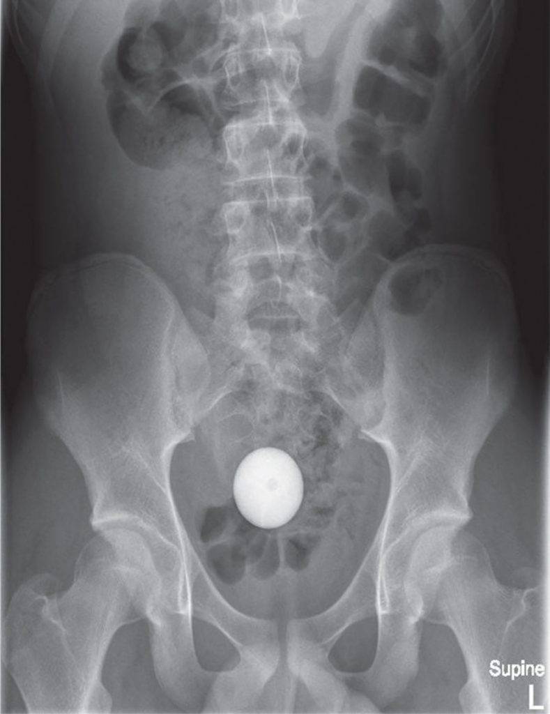 14歲貪玩男 高爾夫球 肛門 X光照片顯示，明顯見到一顆白色球狀異物在腹腔內