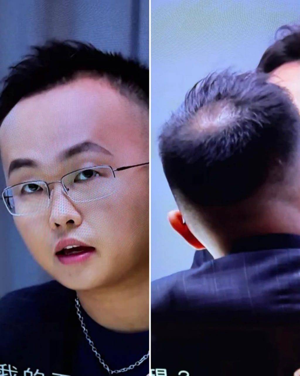 女神配對計劃 十優醫生 十優醫生在醫美機構任職,報稱對「Hair Restoration」有興趣,不過他的髮量就成為討論焦點,節目也不避嫌拍攝他的後腦的「地中海」,被網民笑指係「散熱裝置」。(圖片來源:TVB)