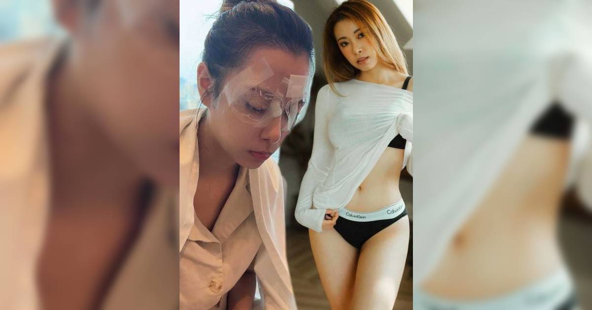 東張女神俞可程激光矯視出意外！「眼角膜摺埋一齊」險失明緊急再入院搶救