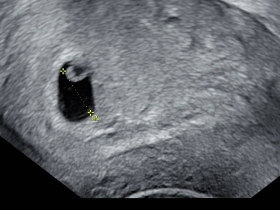 雞排妹 流產 (圖片來源:threads)