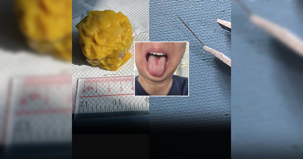 超市燒賣藏鐵針 港女食到成口血報警 涉事燒賣全部下架 食環上門搜證