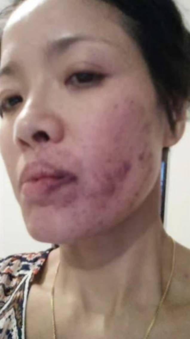 61歲寶珮如曝拍戲被真打傷痕照 半邊臉傷到觸目驚心 出手者竟是金像獎女星