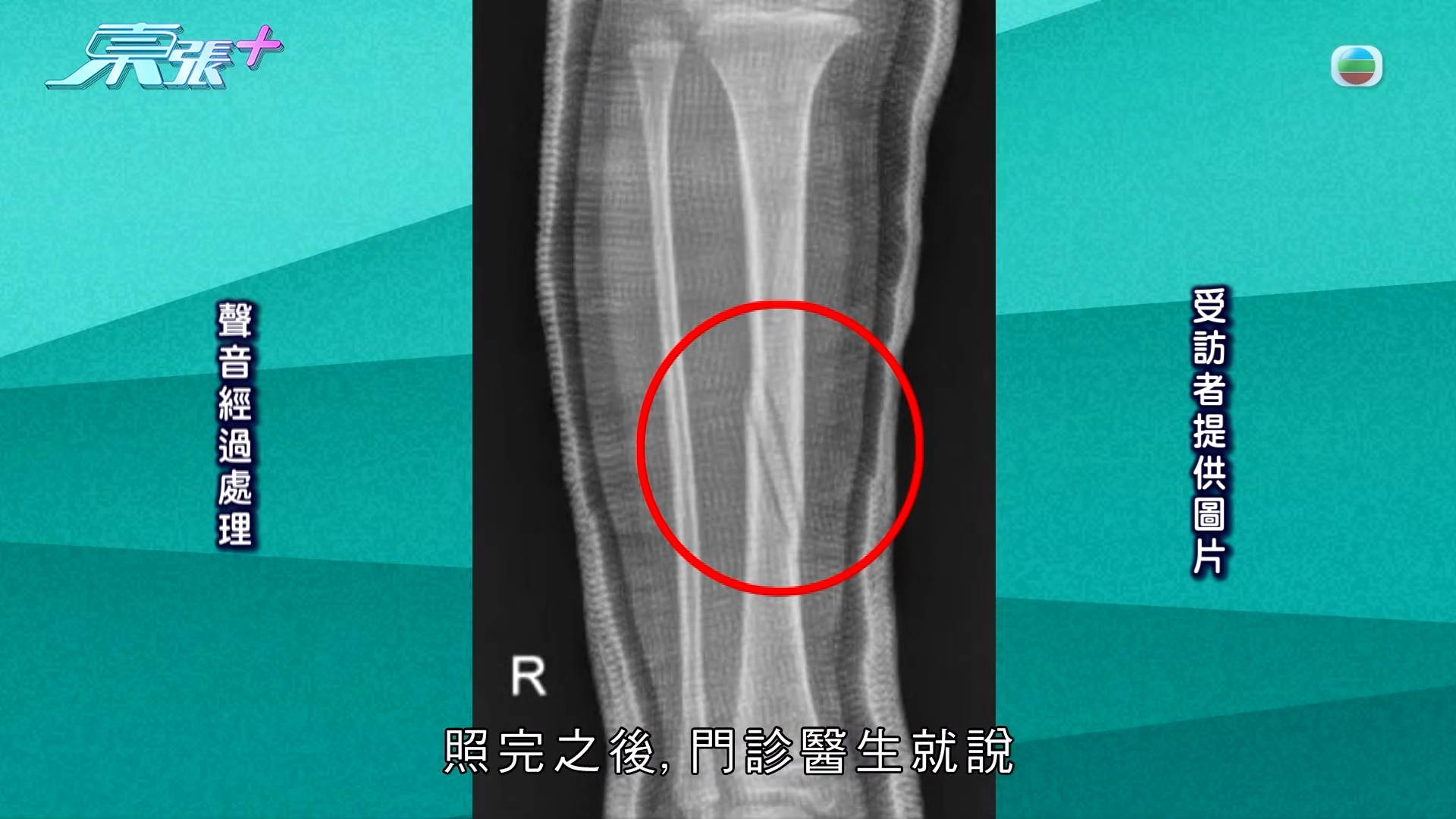 遊樂場意外 兒童安全 經醫生詳細檢查後,確認女童右腳骨裂。(圖片來源:TVB)