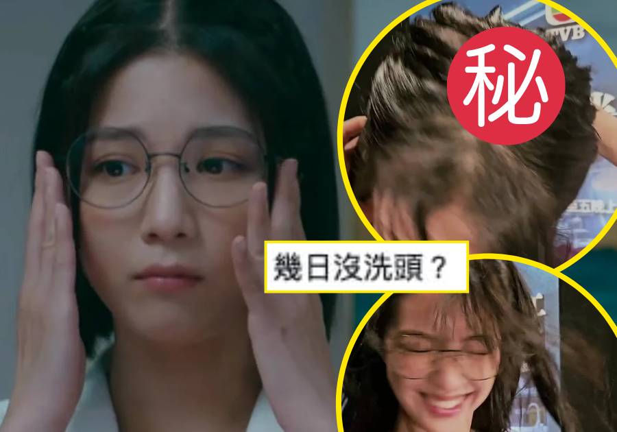 31歲陳曉華「髮縫變寬」疑爆「壓力禿」情傷加上工作量超標網民直呼心痛