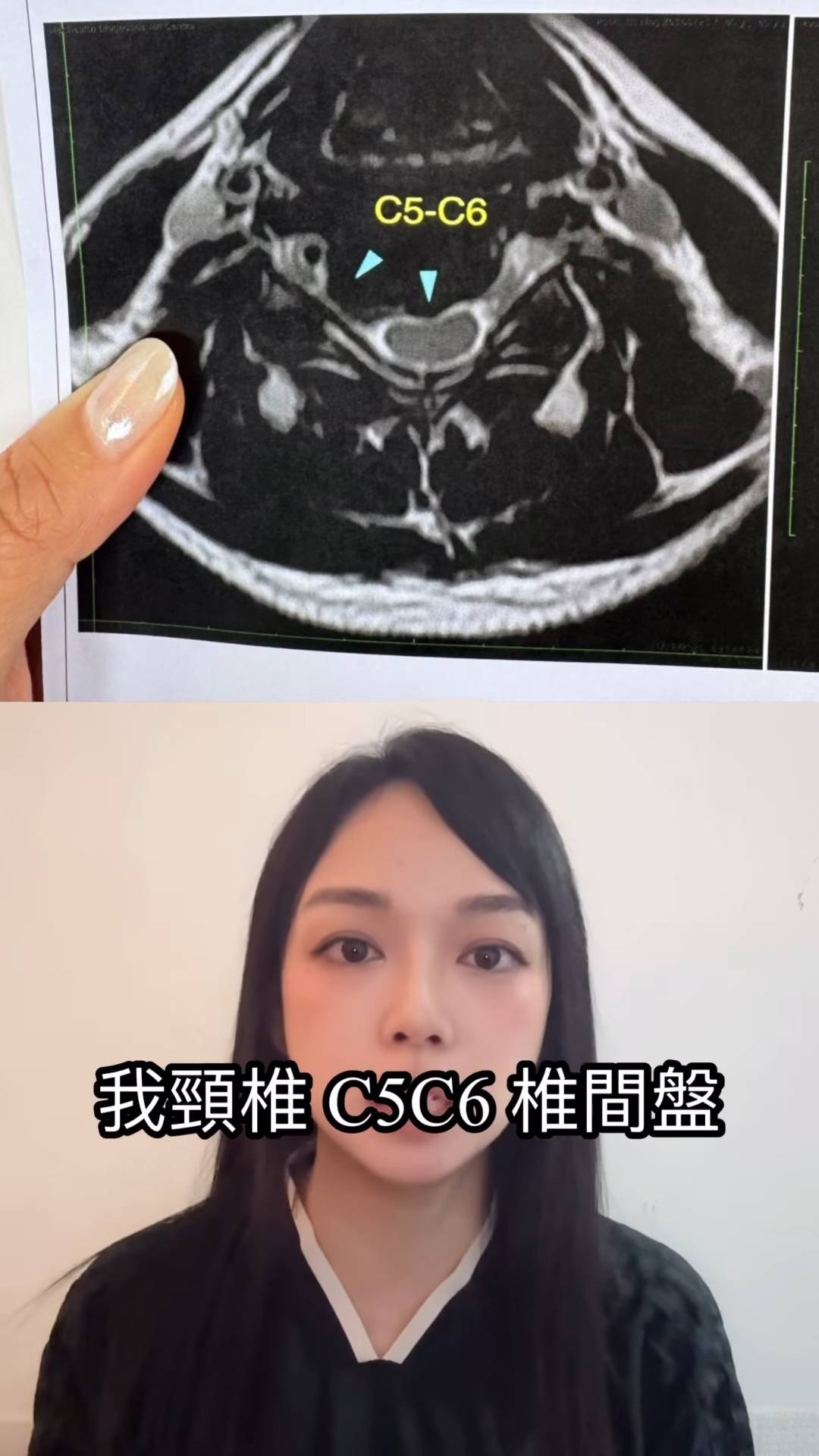 潘杰寧 車禍 一年後發現頸椎C5及C6椎間盤出現大範圍突出,連帶引發頸緊膊痛、頭痛及手部電擊痛,甚至在入睡後亦會痛醒。(圖片來源:IG@kelena.kitning)