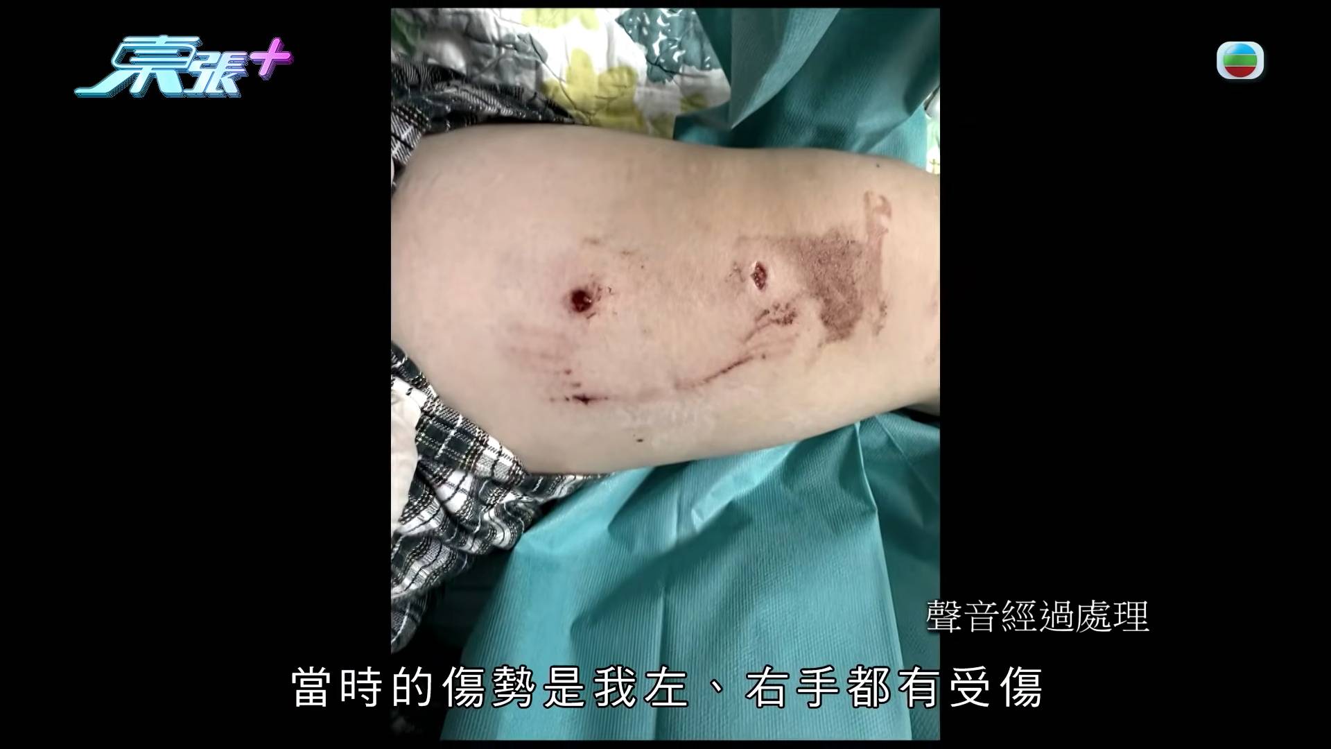 東張西望 惡犬傷人 事主當時左右手都有受傷。(圖片來源:TVB)