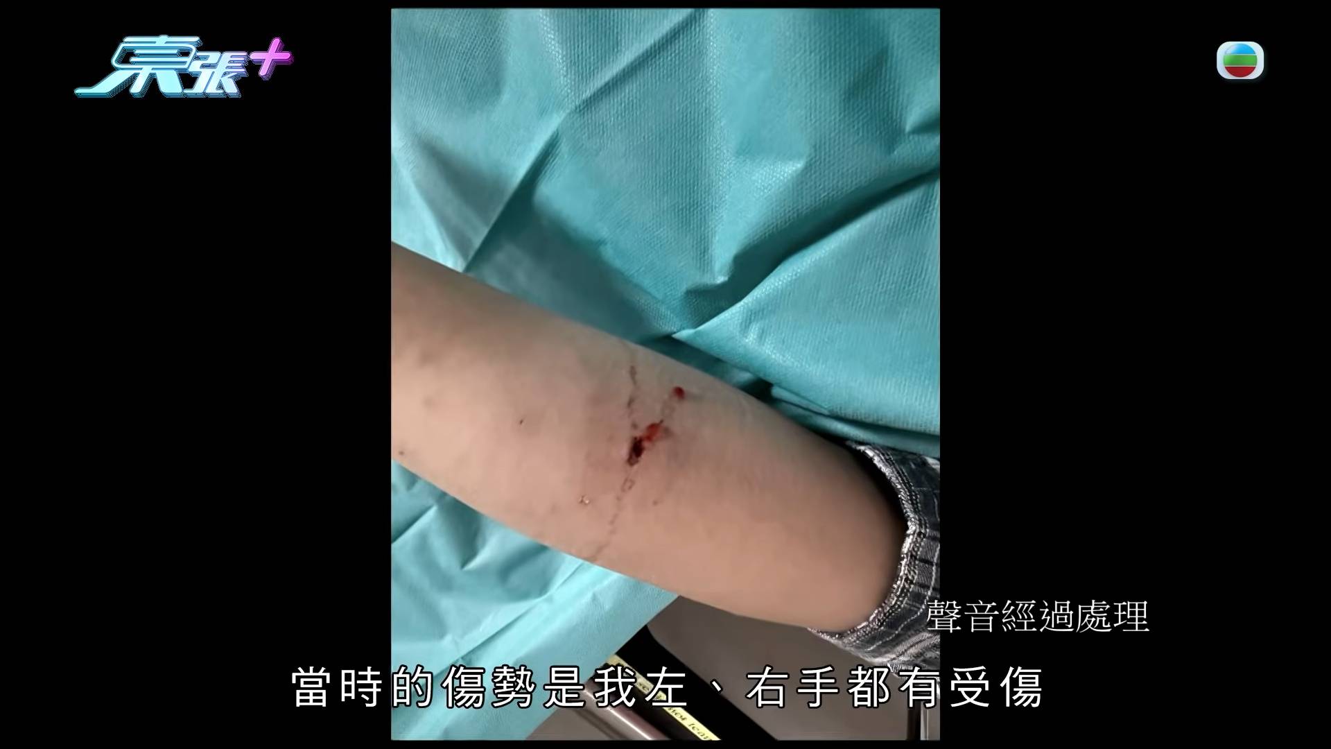 東張西望 惡犬傷人 事主當時左右手都有受傷。(圖片來源:TVB)