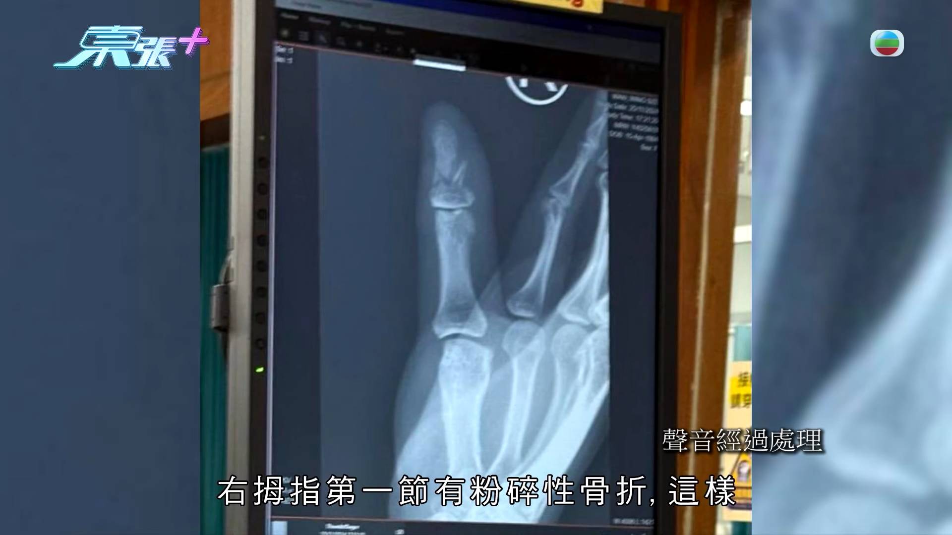 東張西望 惡犬傷人 事主楊小姐拇指被狗咬傷需縫6針,第一節粉碎性骨折。(圖片來源:TVB)