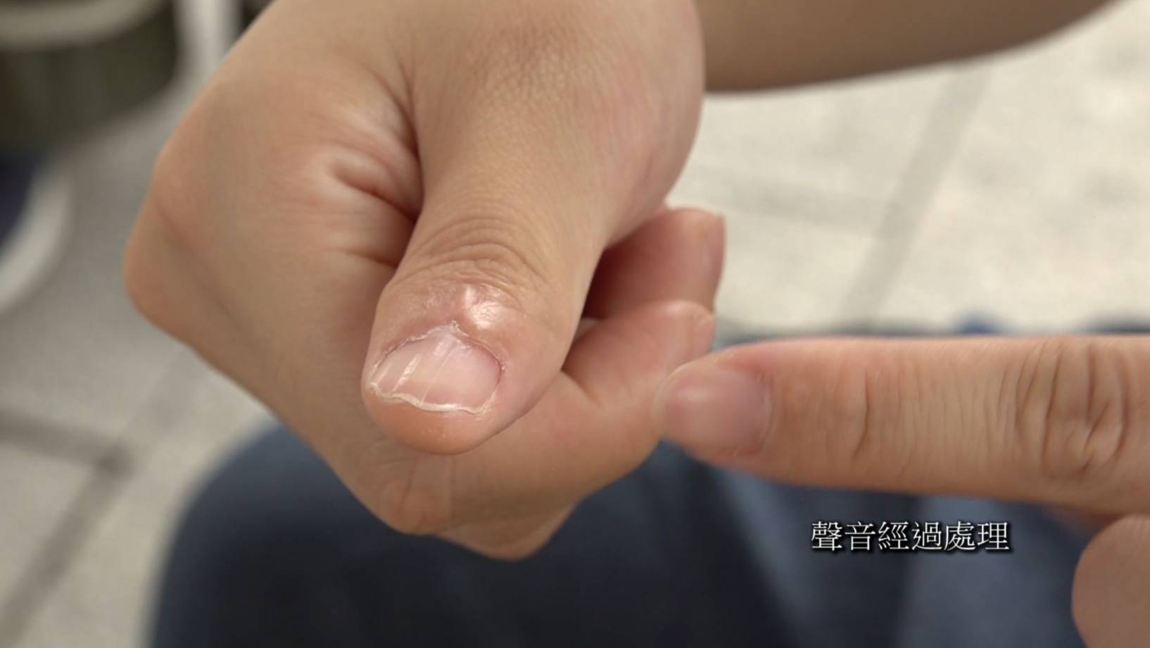 東張西望 惡犬傷人 傷口癒合後拇指嚴重變形且無法發力,連撕包裝紙、拿筷子等日常動作都做不到,徹底失去工作能力。(圖片來源:TVB)