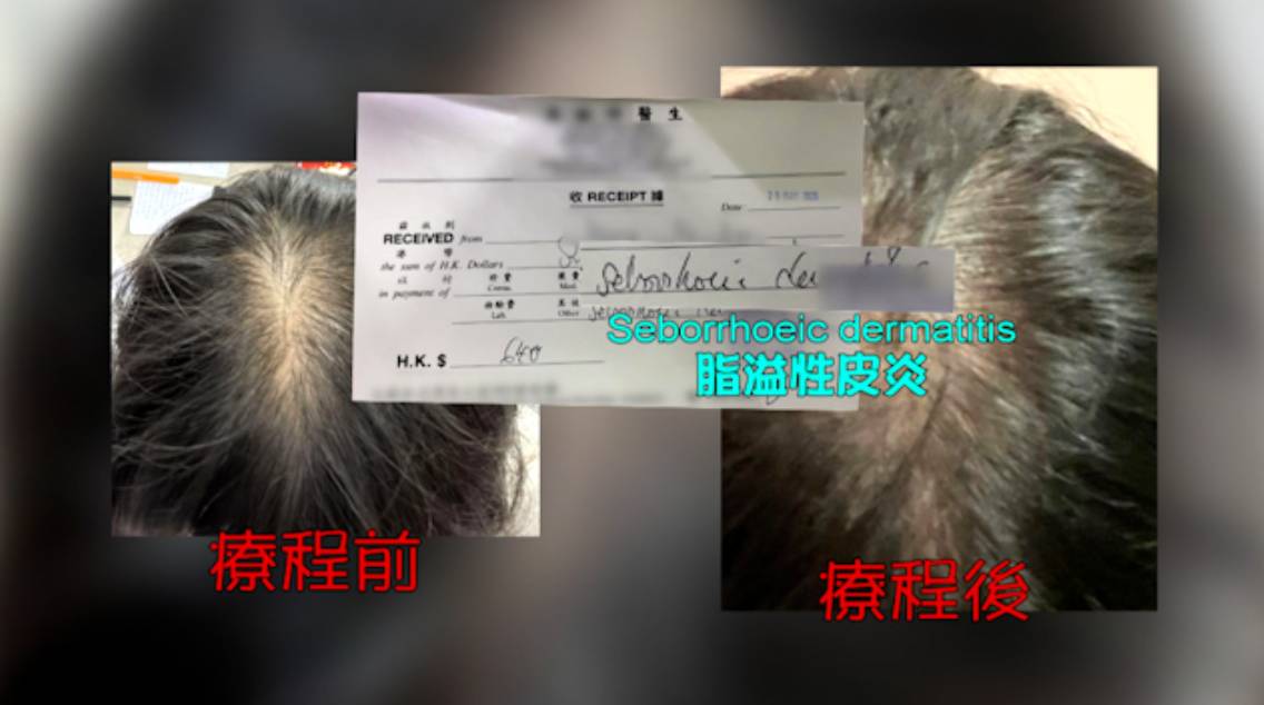 tvb 東張西望 事主求醫後確認為脂溢性皮炎。(圖片來源:TVB)