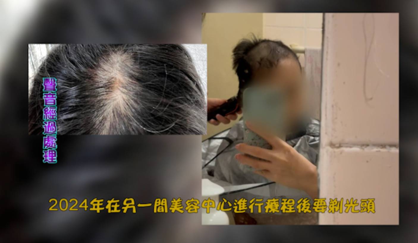 tvb 東張西望 為了生回頭髮,她試過不同方法。她透露,兩年前另一次生髮療程更嚴重,要剃光頭才慢慢好回來,當時亦曾向消委會求助。(圖片來源:TVB)